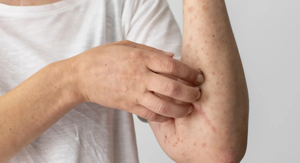 Корь атакует: в Минздраве сообщили о стремительном росте заболеваемости в Украине - today.ua