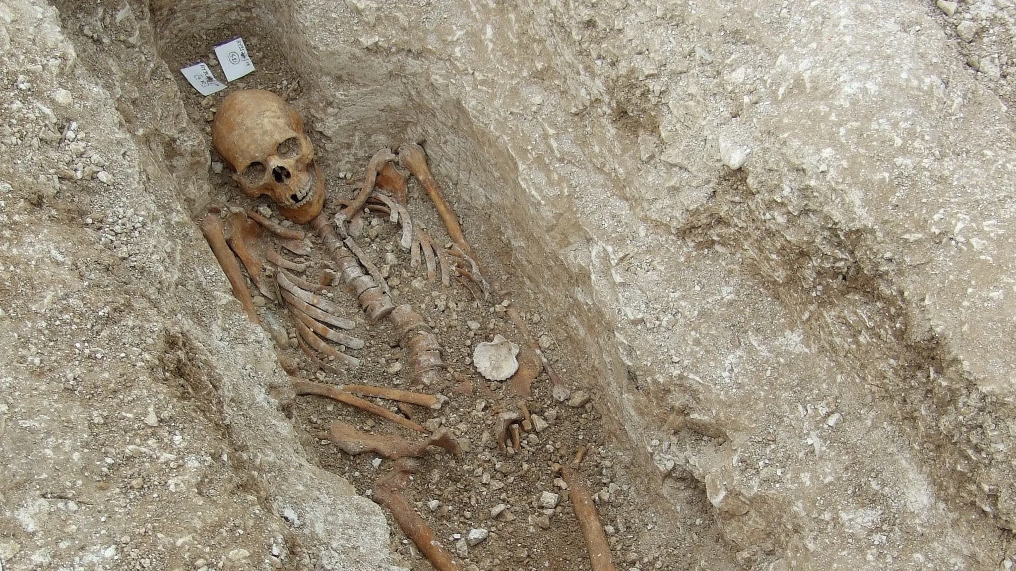 В Европу после длительного забвения вернулась опасная средневековая болезнь - today.ua