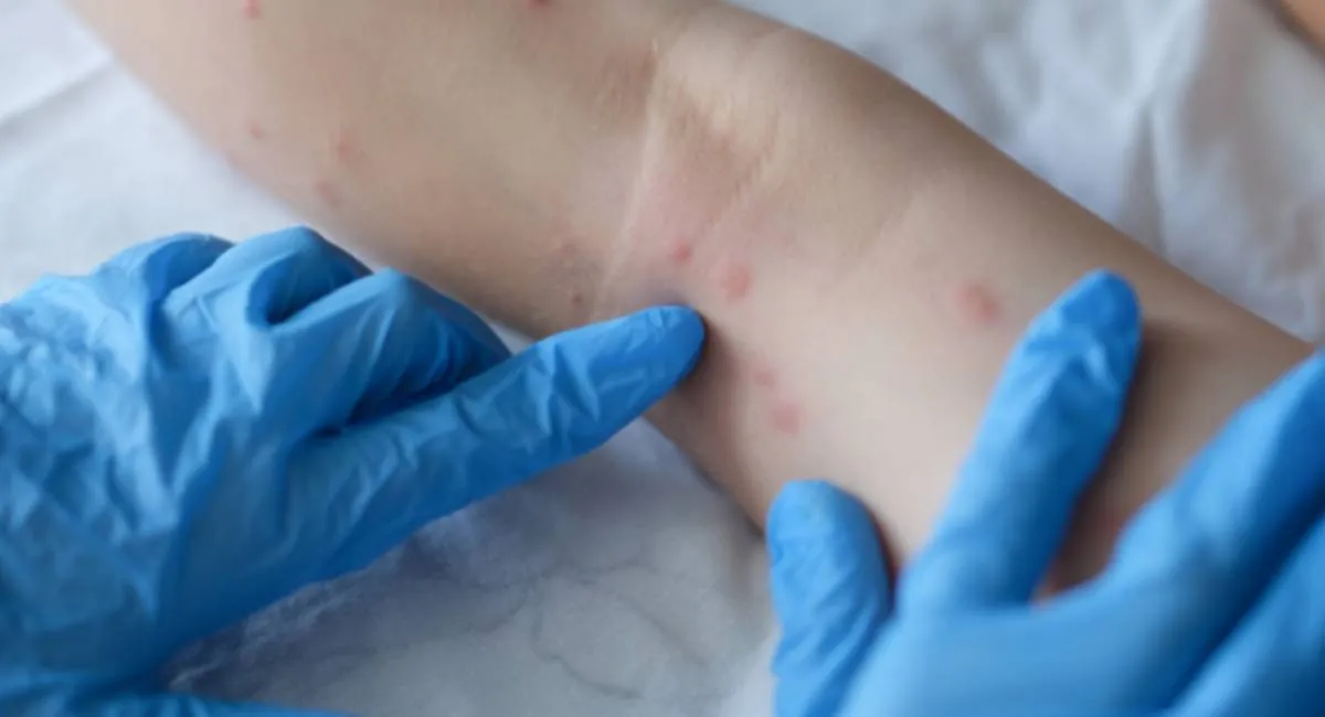 Невідомо, де заразились: у Росії поширюється небезпечна інфекція - today.ua
