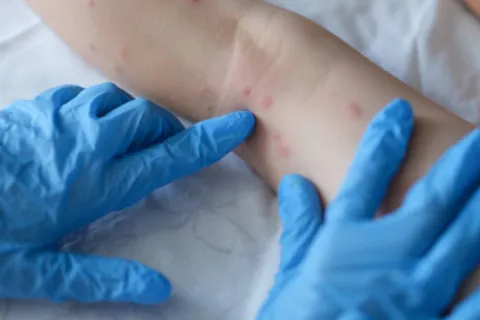 Невідомо, де заразились: у Росії поширюється небезпечна інфекція