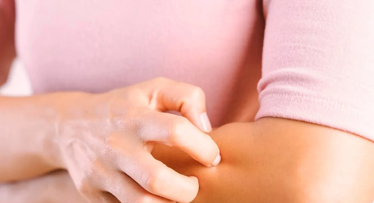 Как лечить укусы насекомых: дерматолог назвала важные правила для взрослых и детей - today.ua
