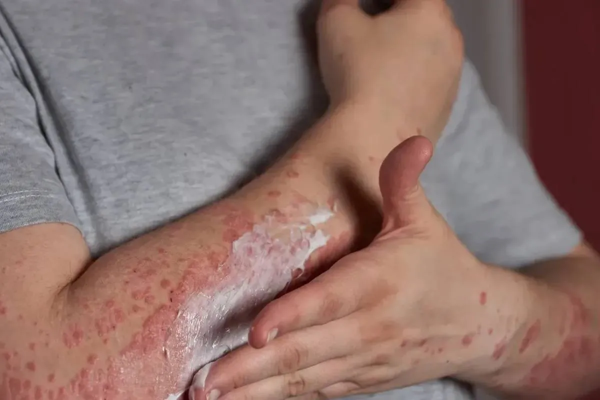 Устойчивый к лекарствам и чрезвычайно заразный: в Европе распространяется новый супергрибок Устойчивый к лекарствам и чрезвычайно заразный: в Европе распространяется новый супергрибок - today.ua