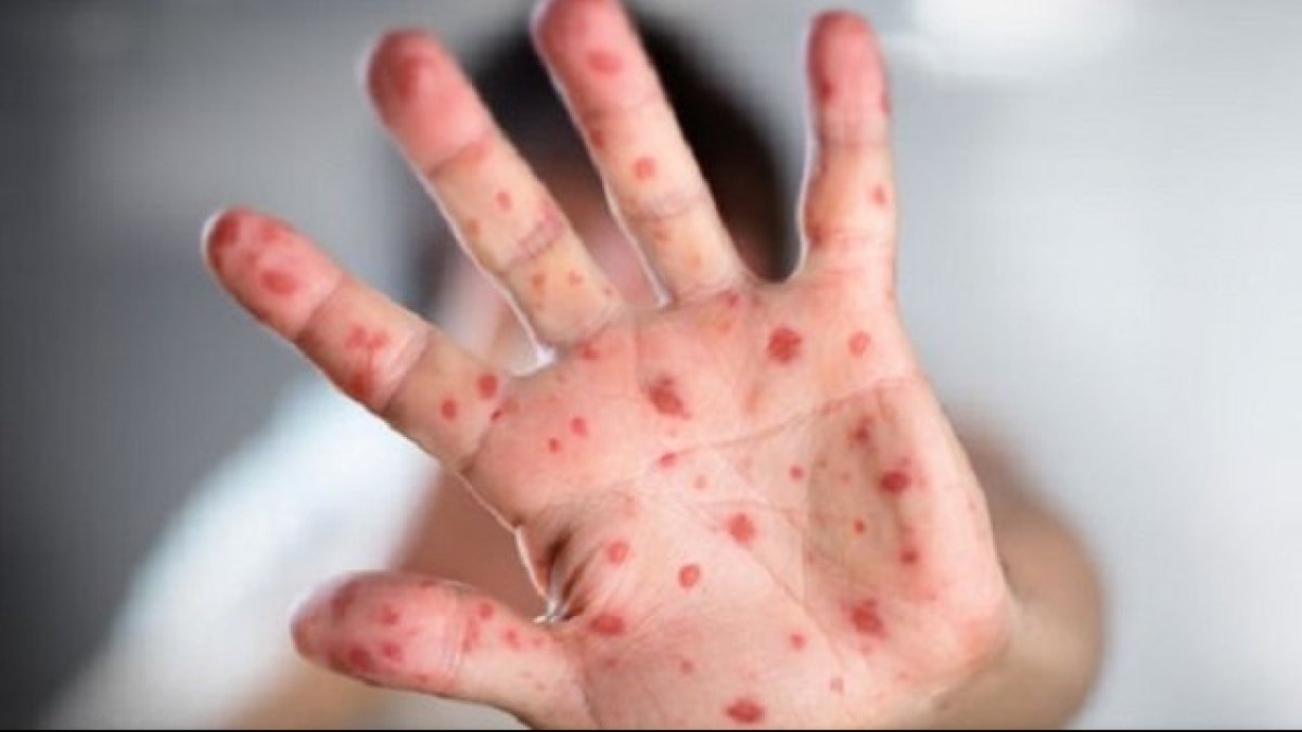 Більше 700 людей В Україні захворіли на кір