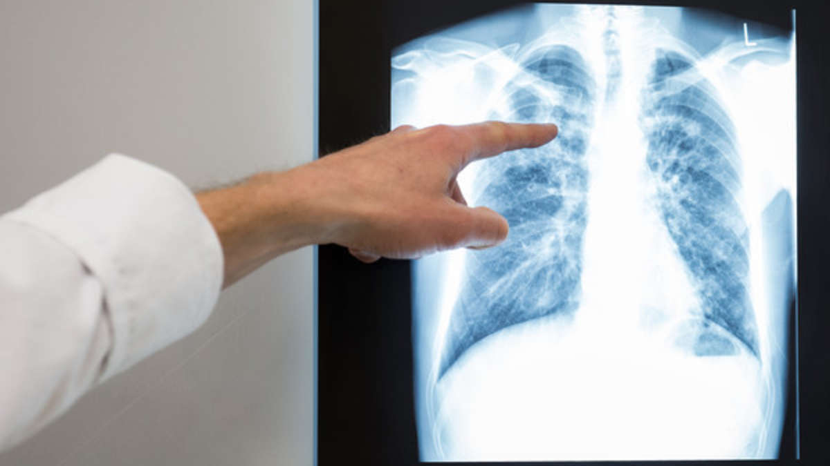 Супрун ошарашила новостью: 50 процентов украинцев – носители туберкулеза - today.ua