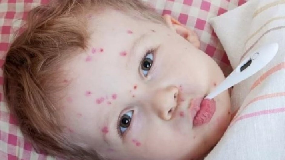 В Минздраве приняли решение относительно эпидемии кори в Украине