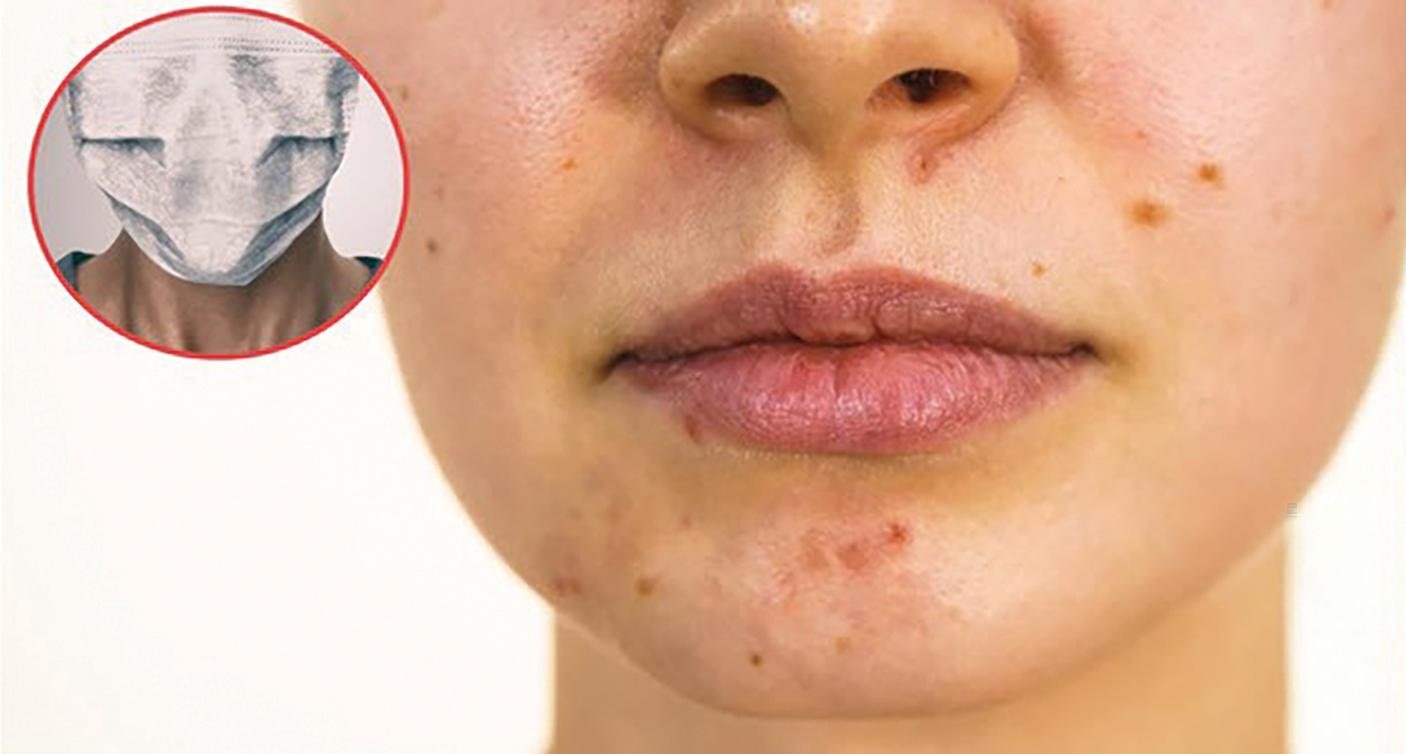 Медицинская маска портит кожу лица: спасительные советы косметолога