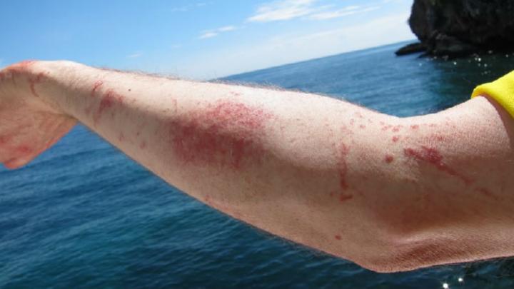 Медузы атакуют: что делать, если вас ужалил ядовитый морской обитатель
