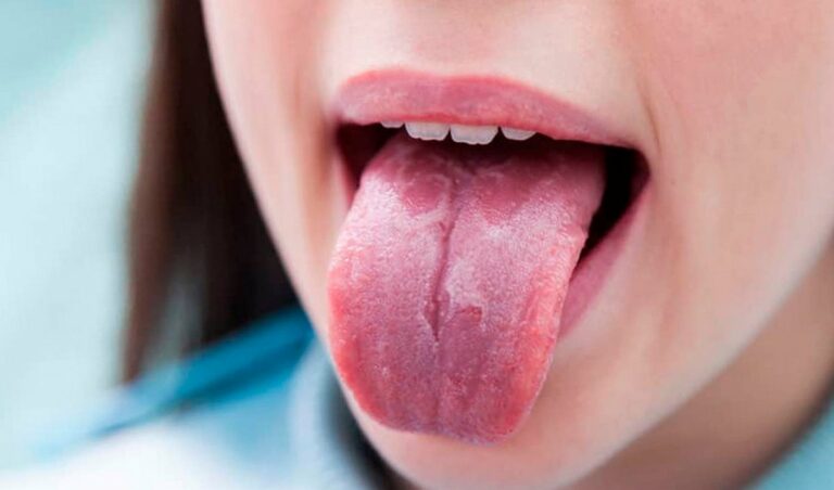 Новый симптом коронавируса: язык “расскажет“ о вашем состоянии здоровья - today.ua