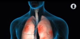 Пневмонія і застуда: лікар розповів, як їх розрізняти, щоби не прогавити небезпеку - today.ua