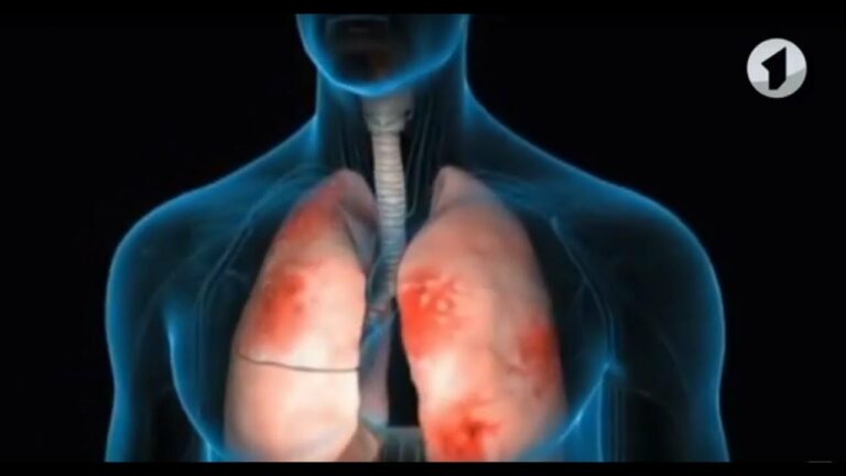 Пневмония и простуда: врач  рассказал, как их различать, чтобы не пропустить опасность - today.ua
