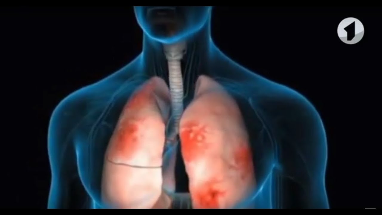 Пневмония и простуда: врач  рассказал, как их различать, чтобы не пропустить опасность