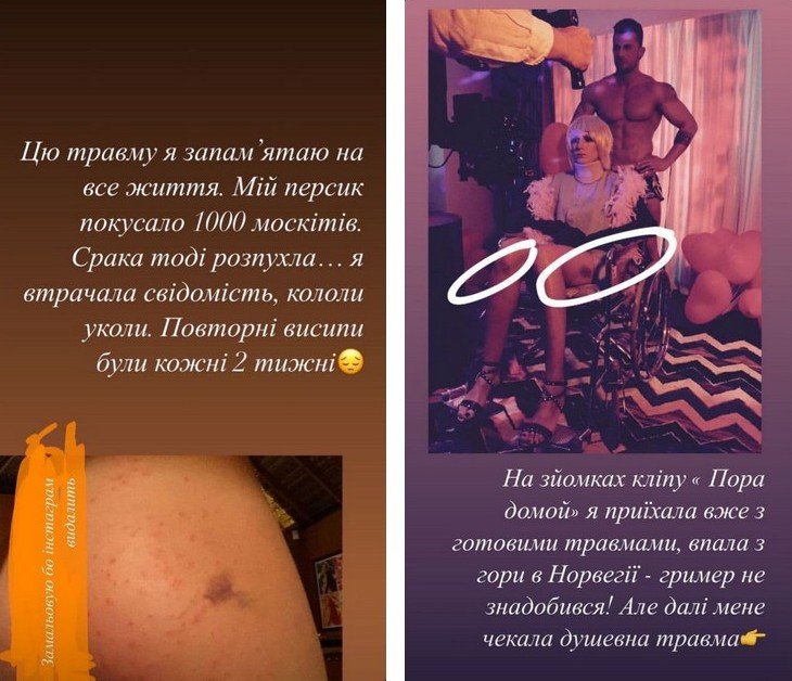 “Шкіра злазила два тижні“: Леся Нікітюк показала своє тіло в синцях і укусах