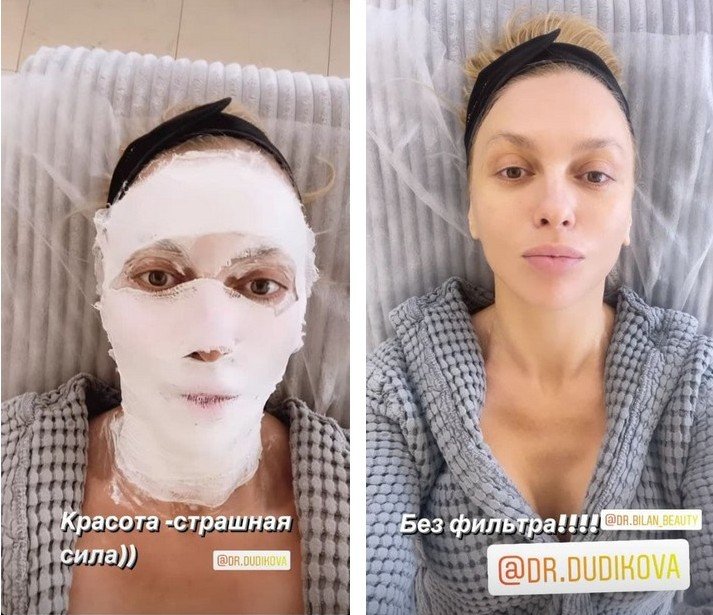 Оля Полякова с перебинтованным лицом показала, как выглядит после омолаживающей процедуры
