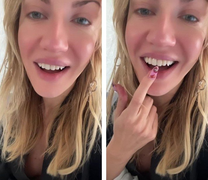 Леся Нікітюк зламала передній зуб: фото
