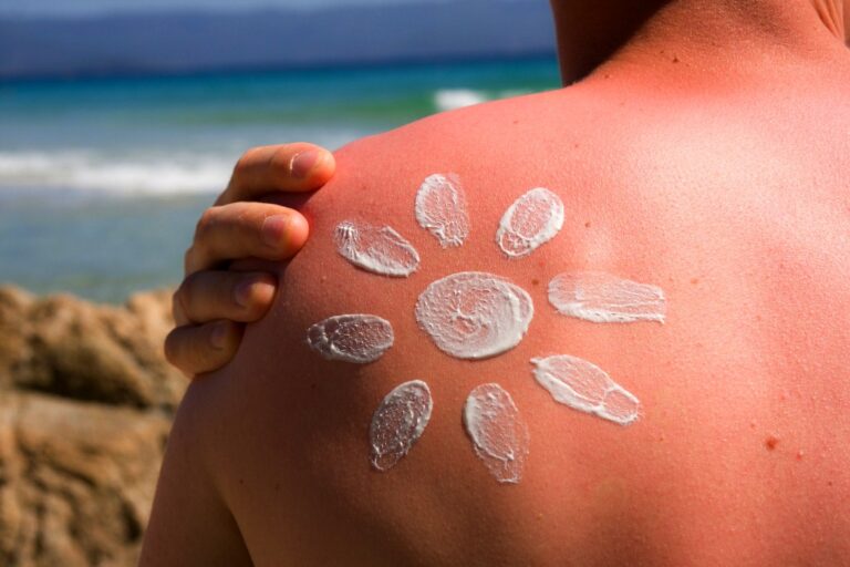Никакой сметаны: как спасти кожу после солнечного ожога летом - today.ua