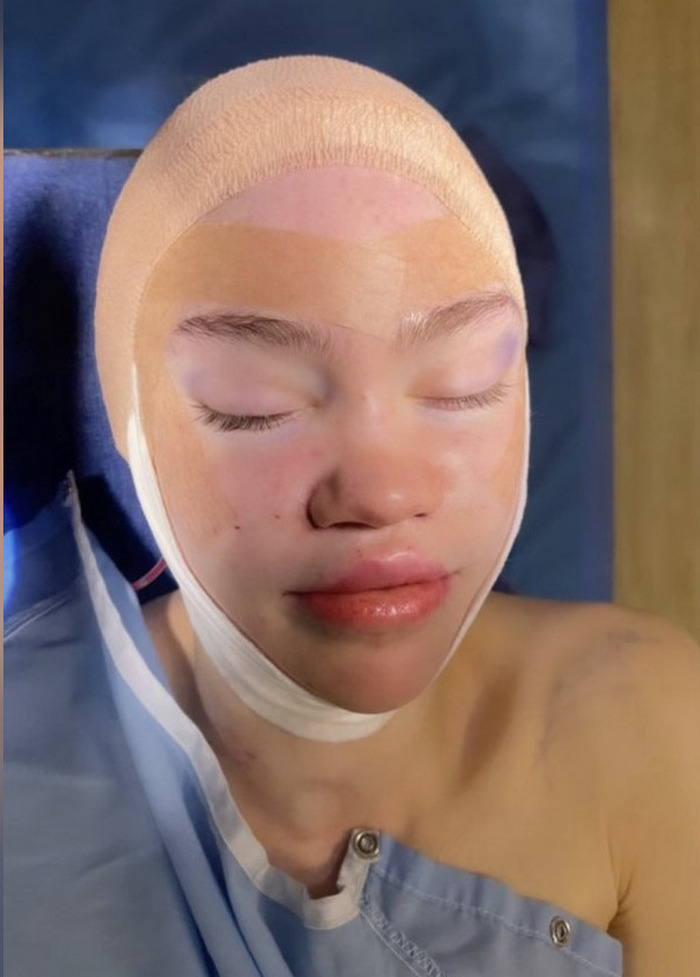 Бывшая девушка Илона Маска сделала пластику и показала свое лицо в синяках - today.ua