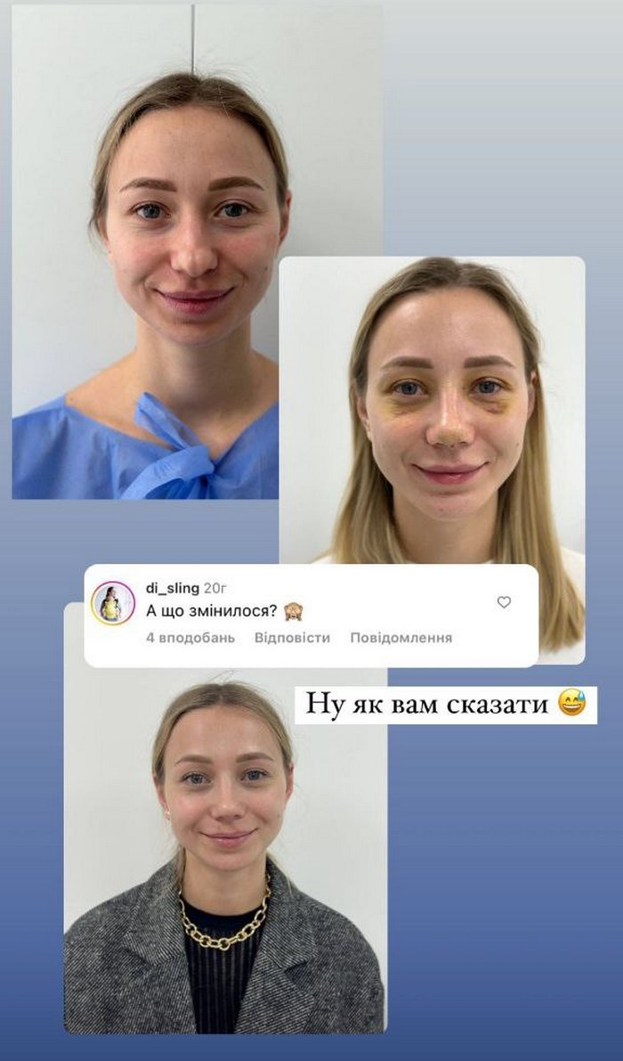 Дружина Віктора Павлика показала, як виглядає через 4 місяці після пластики обличчя: “А що змінилося?“
