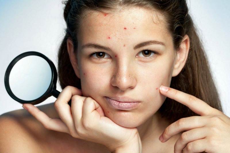 Медики рассказали, о каких проблемах со здоровьем могут сигнализировать прыщи на лице