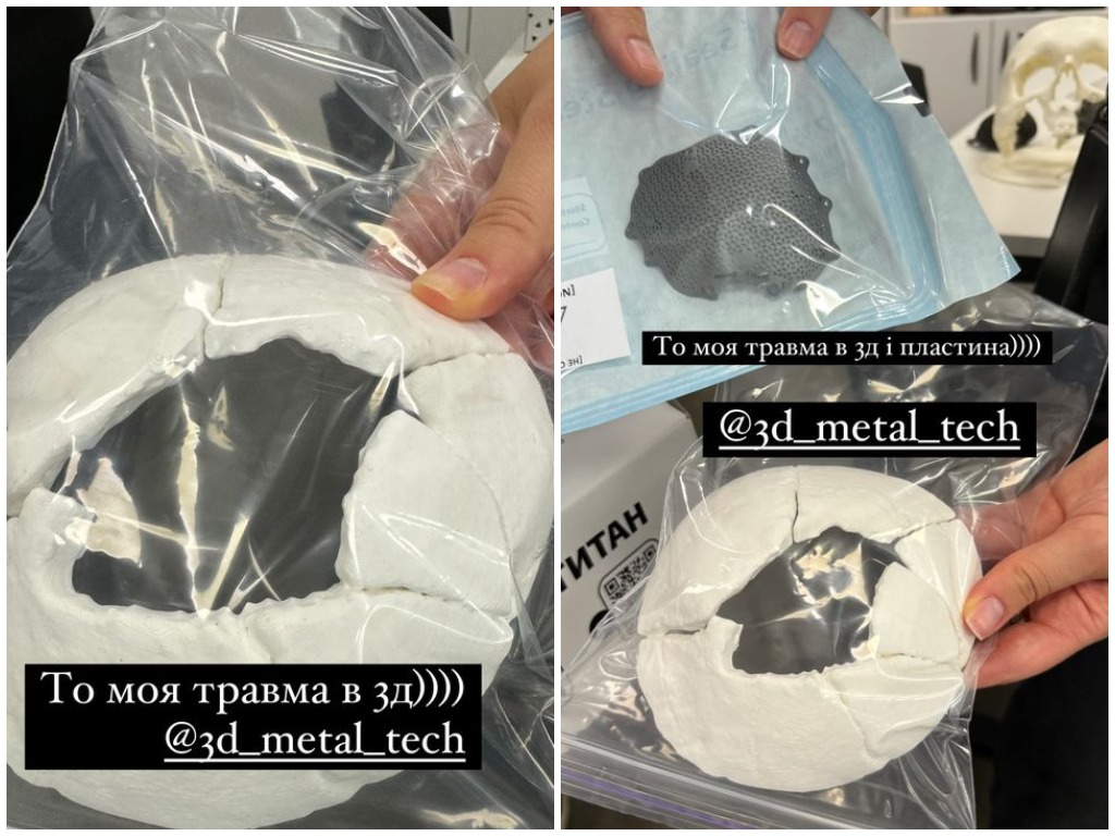 Виктор Розовый показал результаты новой операции на черепе: Железа в голове стало больше - today.ua