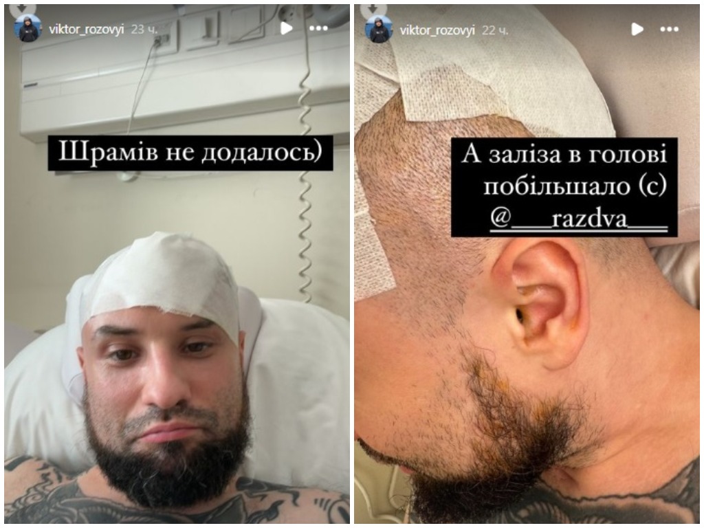 Виктор Розовый показал результаты новой операции на черепе: Железа в голове стало больше - today.ua